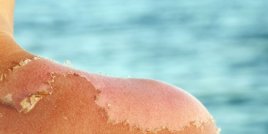 Какво да направите, когато кожата ви започне да се бели след слънчево изгаряне 