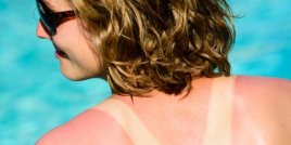 Колко дълго трае слънчево изгаряне преди да изчезне - и как да се ускори лечението