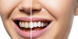  5 естествени начина за избелване на зъбите