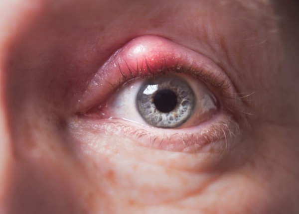 Ечемик на окото, Лечение: 5  средства за домашно лечение