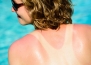 Колко дълго трае слънчево изгаряне преди да изчезне - и как да се ускори лечението